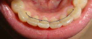 ریتینر - عوارض ارتودنسی دندان