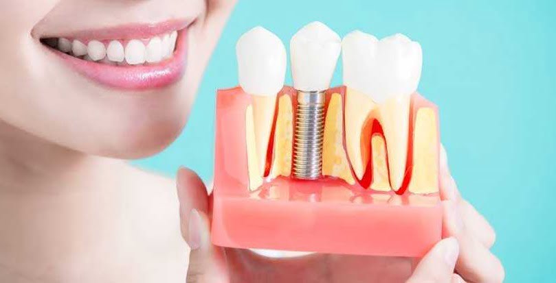 خطرات و مزایا ایمپلنت دندان