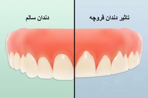 دندان های سالم - بروکسیم
