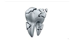 شکستگی دندان - دندان درد